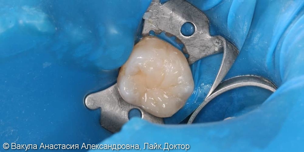Лечение кариеса зуба 36, восстановление анатомической формы - фото №2