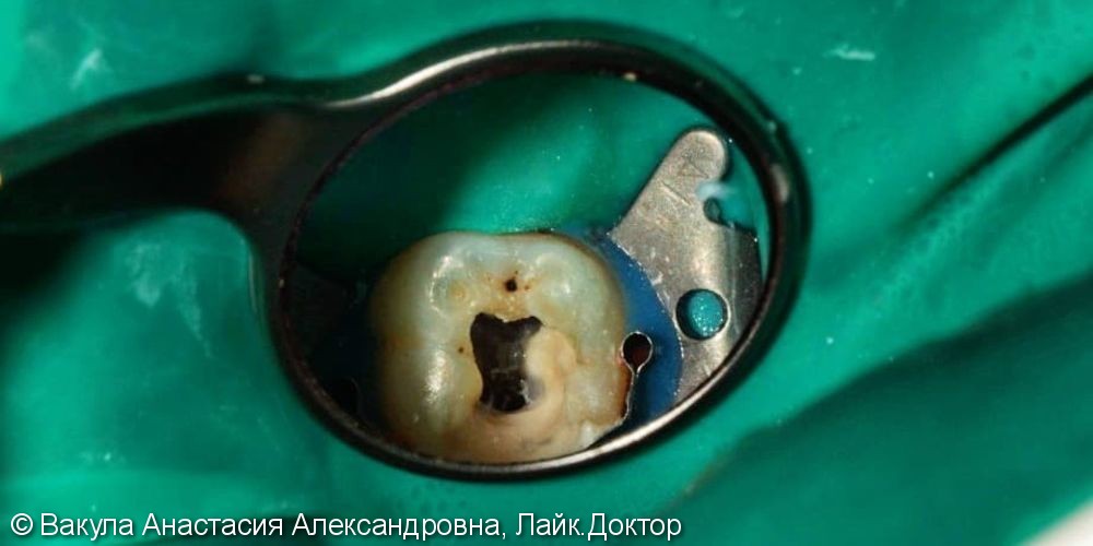 Лечение пульпита, зуб 46, восстановление анатомической формы - фото №1