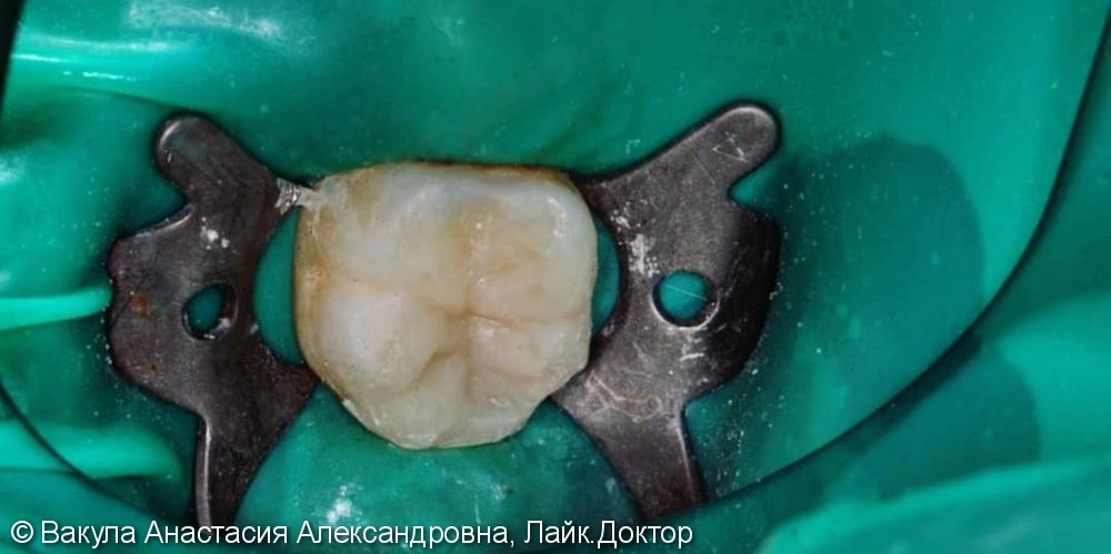 Лечение пульпита, зуб 46, восстановление анатомической формы - фото №2