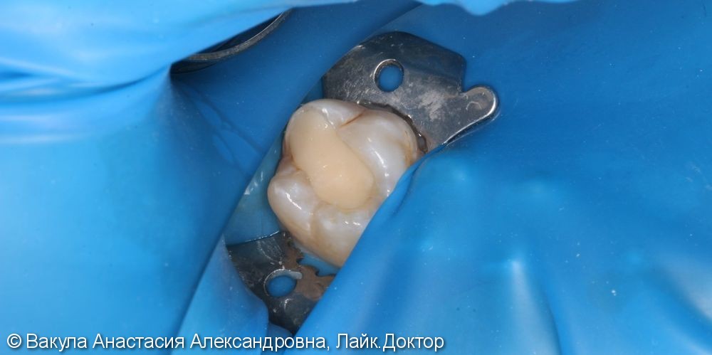 Лечение кариеса жевательного зуба - фото №1