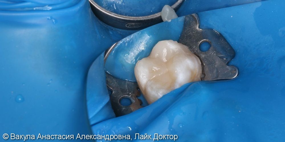 Лечение кариеса жевательного зуба - фото №2