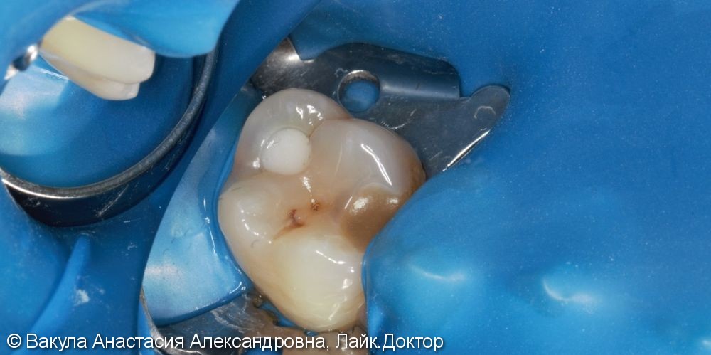 Лечение кариеса дентина зуба 26, до и после - фото №1