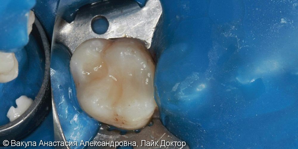 Лечение кариеса дентина зуба 26, до и после - фото №2