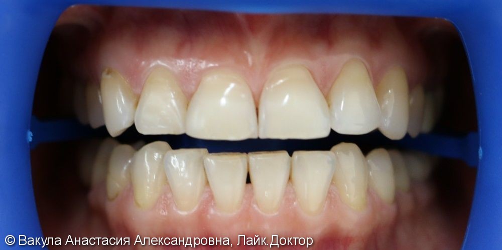 Результат отбеливания зубов ZOOM 4, до и после - фото №1