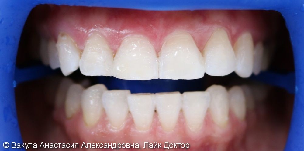 Результат отбеливания зубов ZOOM 4, до и после - фото №2