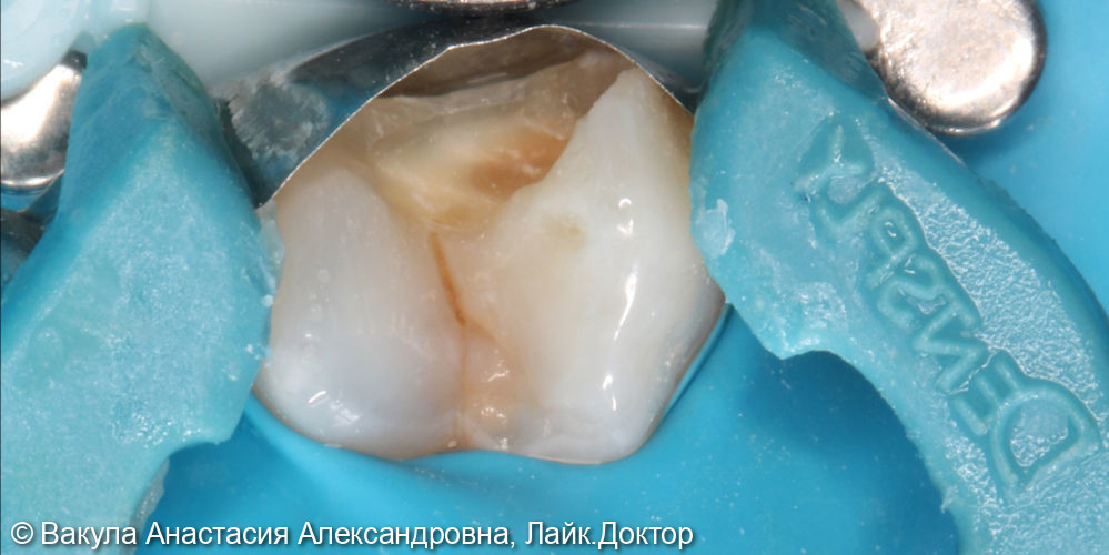 Лечение кариеса и реставрация зуба 2.4 с восстановлением контактного пункта - фото №1