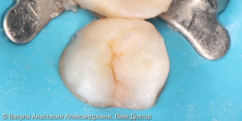Лечение кариеса и реставрация зуба 2.4 с восстановлением контактного пункта - фото №2