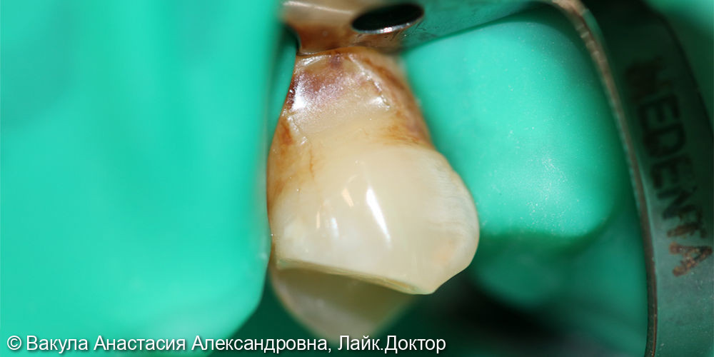 Лечение кариеса дентина зуба 2.4 - фото №1