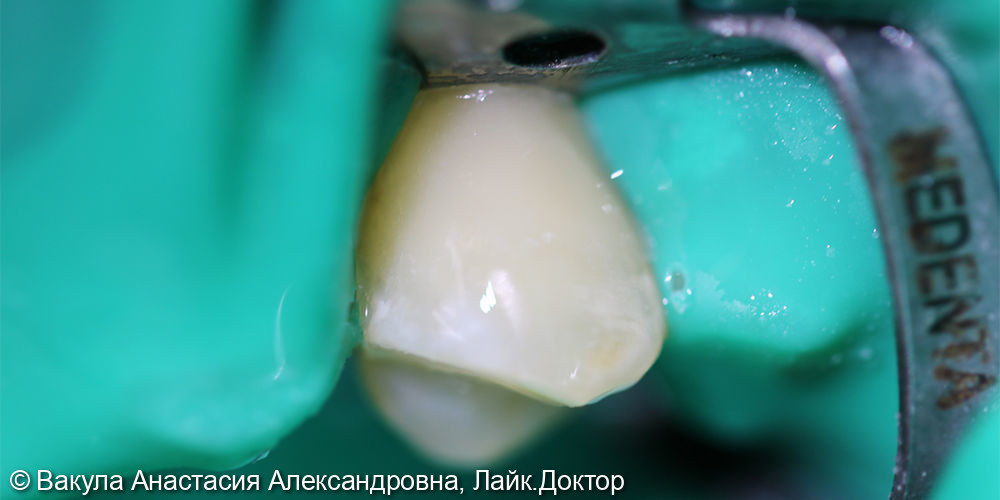 Лечение кариеса дентина зуба 2.4 - фото №2