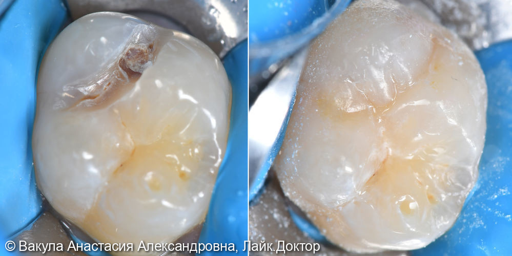 Лечение кариеса дентина зуба 16 - фото №1