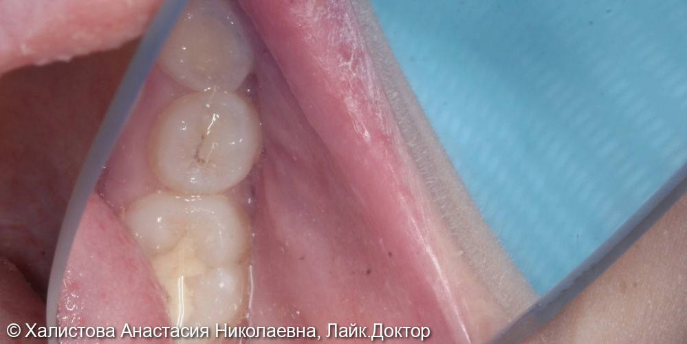 Лечение среднего кариеса зуба 3.5 - фото №1