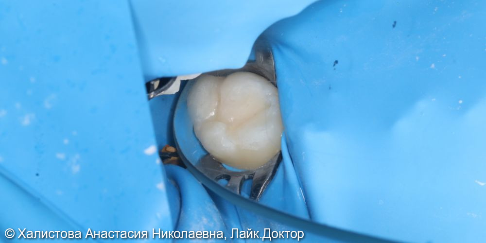 Лечение среднего кариеса 1.6 зуба - фото №2