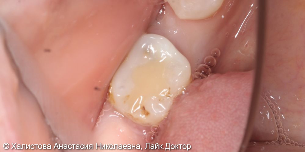 Лечение глубокого кариеса 4.6 зуба - фото №1