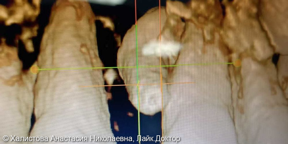 Удаление ретенированного сверхкомплектного зуба в области 1.1, 2.1 - фото №1