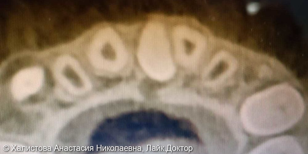 Удаление ретенированного сверхкомплектного зуба в области 1.1, 2.1 - фото №2