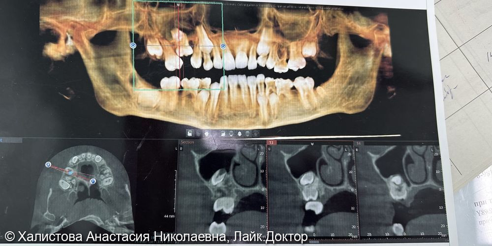 Удаление ретенированного 5.5 зуба - фото №1
