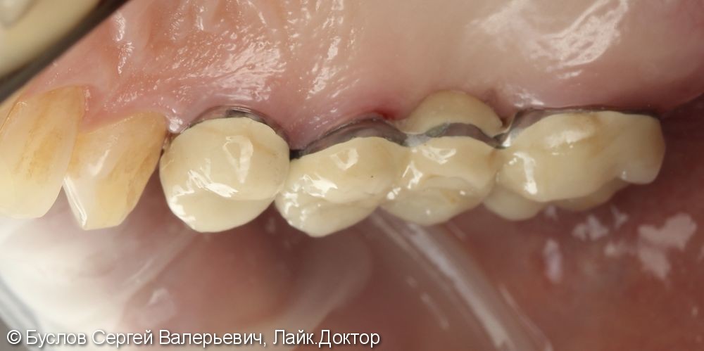 Лечение отсутствующего 16 жевательного зуба на верхней челюсти слева - фото №4