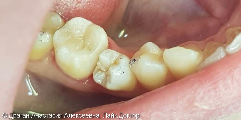 Лечение глубокого кариеса сбоку жевательного зуба - фото №2