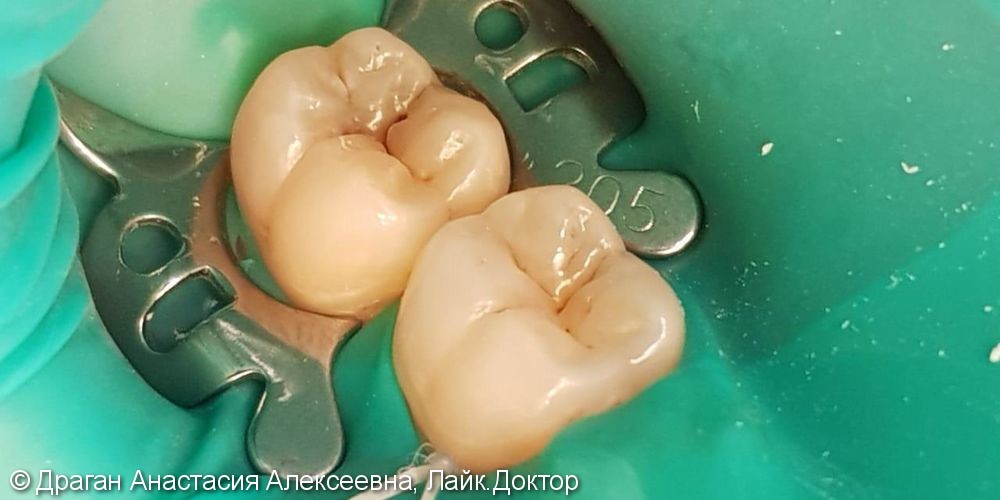 Лечение глубокого кариеса 47 зуба, до и после - фото №1