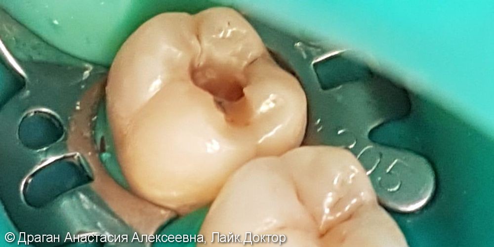 Лечение глубокого кариеса 47 зуба, до и после - фото №2