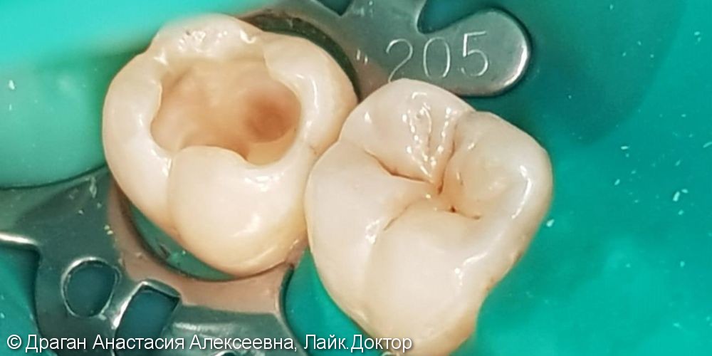 Лечение глубокого кариеса 47 зуба, до и после - фото №3