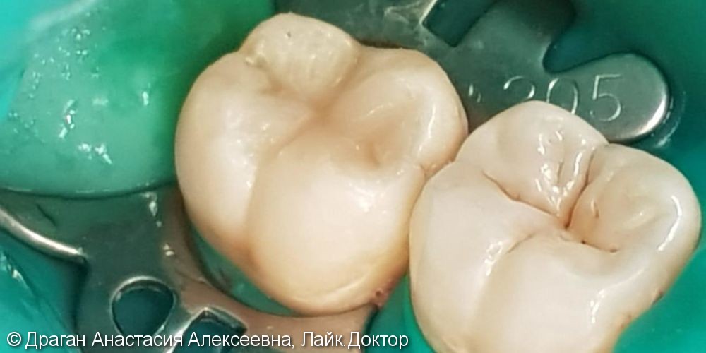 Лечение глубокого кариеса 47 зуба, до и после - фото №4