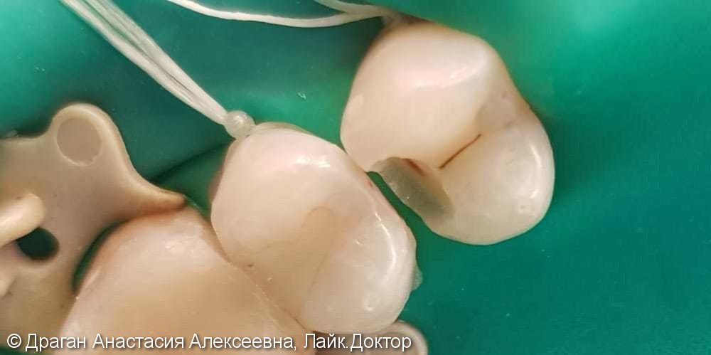 Лечение кариеса 15 зуба - фото №3