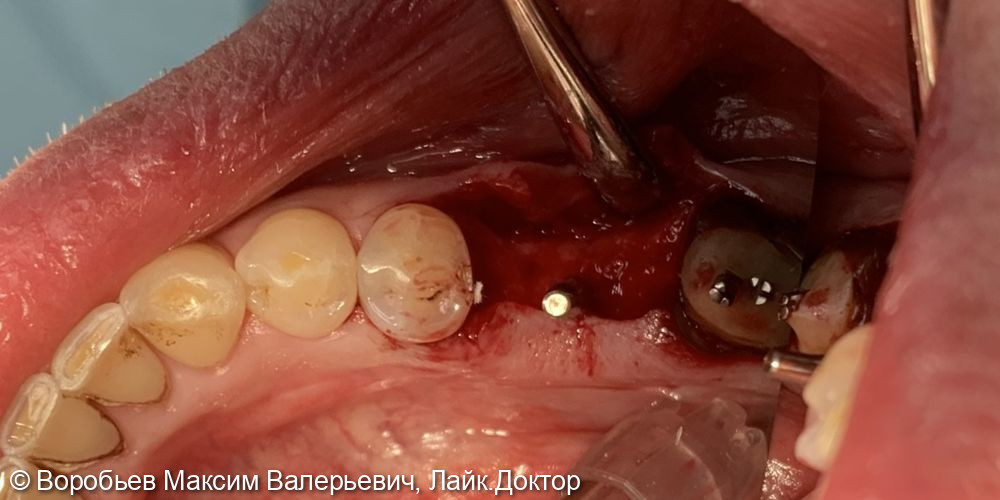 Имплантация в области 46 зуба - фото №2