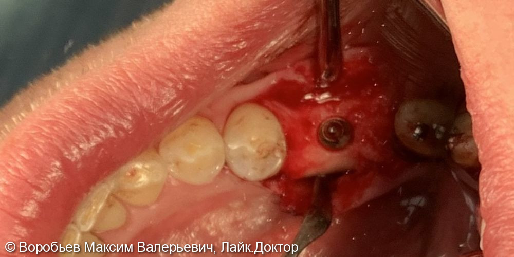 Имплантация в области 46 зуба - фото №3