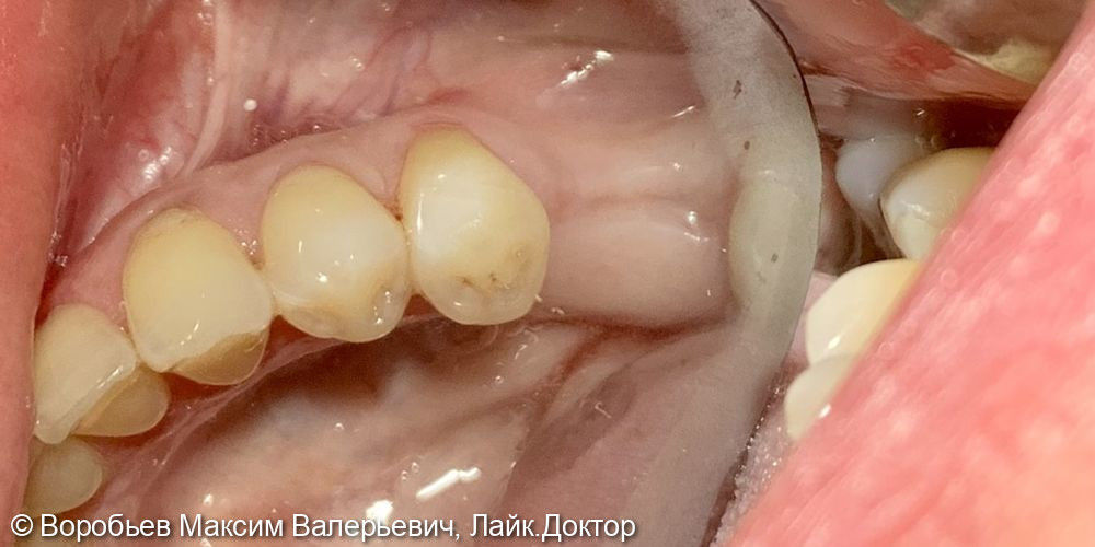 Плановая имплантация в области 3.6 и 4.6 зубов - фото №1