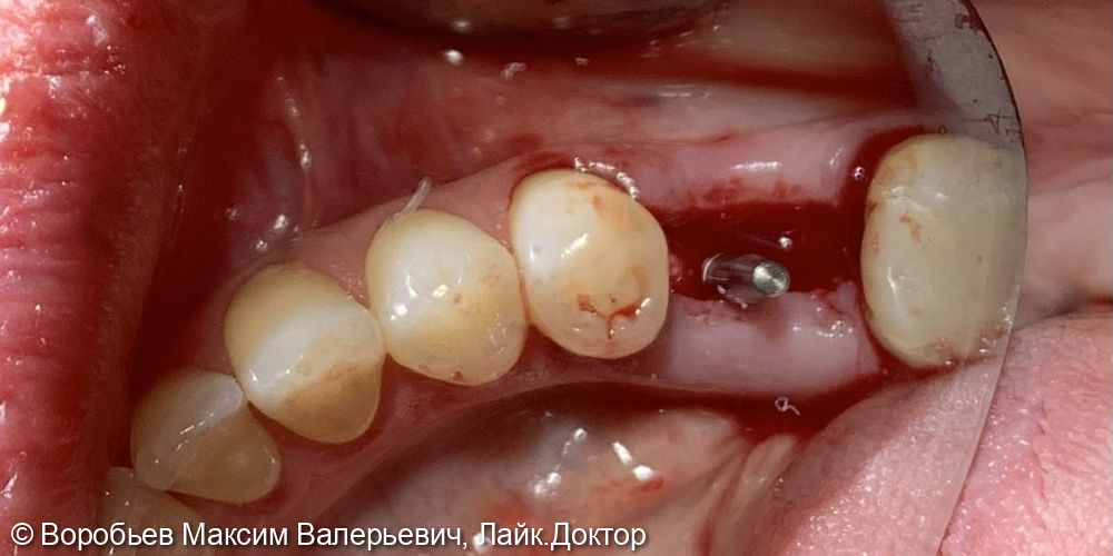 Плановая имплантация в области 3.6 и 4.6 зубов - фото №2