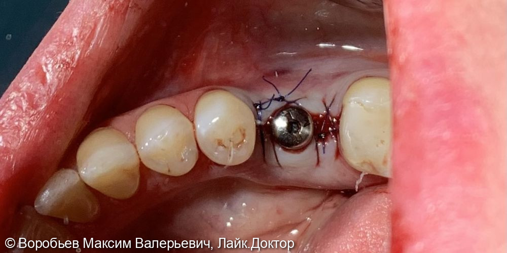 Плановая имплантация в области 3.6 и 4.6 зубов - фото №3