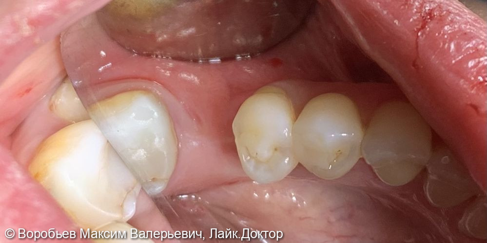 Плановая имплантация в области 3.6 и 4.6 зубов - фото №4