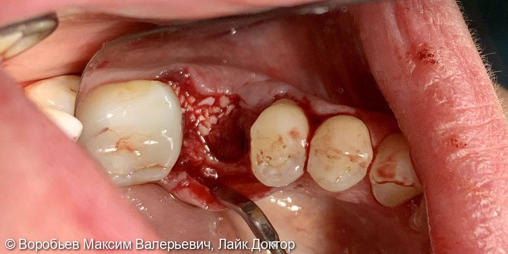 Плановая имплантация в области 3.6 и 4.6 зубов - фото №5
