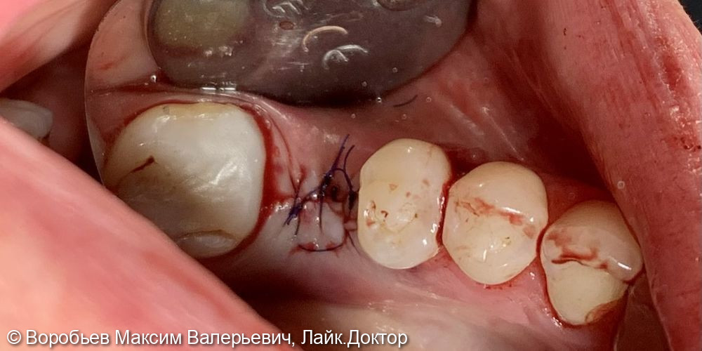 Плановая имплантация в области 3.6 и 4.6 зубов - фото №6