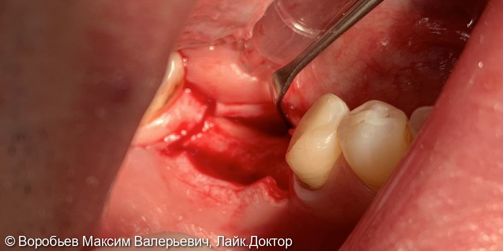 Имплантация в области 4.5 и 4.6 зубов - фото №1