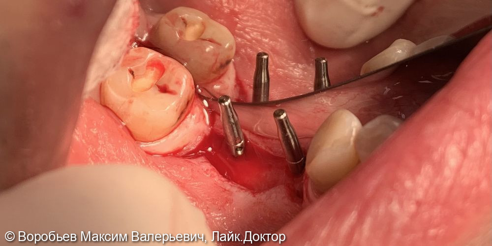 Имплантация в области 4.5 и 4.6 зубов - фото №2