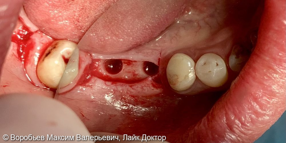 Имплантация в области 4.5 и 4.6 зубов - фото №3