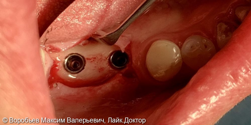 Имплантация в области 4.5 и 4.6 зубов - фото №4