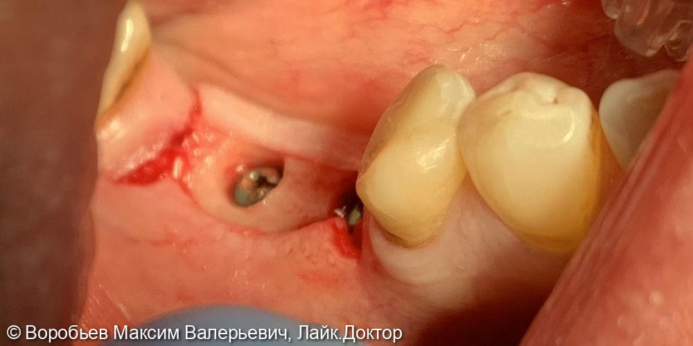 Имплантация в области 4.5 и 4.6 зубов - фото №5