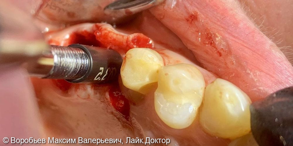 удаление 27 и имплантация в области 26 зуба - фото №3