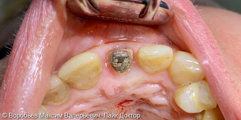 Удаление и имплантация 21 зуба - фото №1