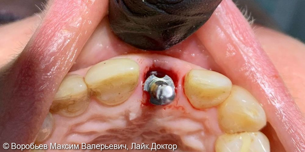 Удаление и имплантация 21 зуба - фото №4