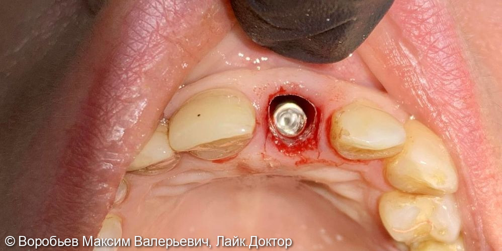 Удаление и имплантация 21 зуба - фото №6