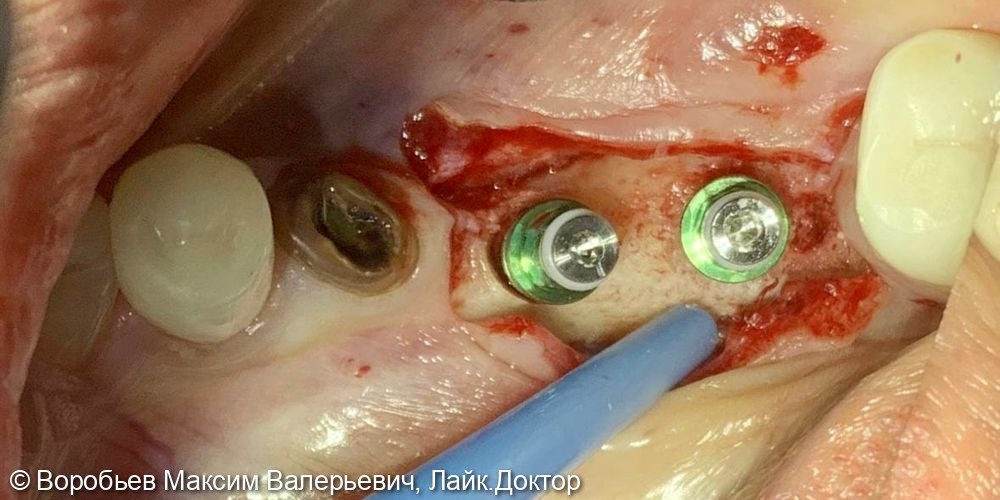 Имплантация в области 46 и 47 зубов - фото №5