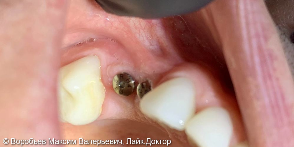 Имплантация в области 24 и 25 зуба и Пластика мягких тканей - фото №1