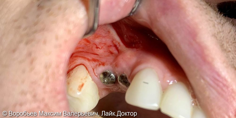 Имплантация в области 24 и 25 зуба и Пластика мягких тканей - фото №4