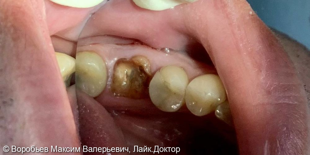 удаление 36 го зуба и одномоментная имплантация в области 36 го зуба - фото №1