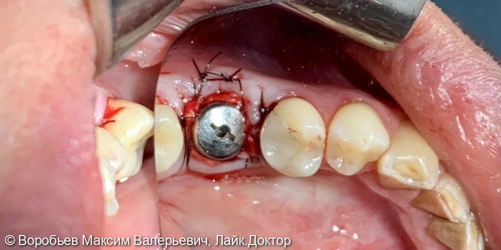удаление 36 го зуба и одномоментная имплантация в области 36 го зуба - фото №4