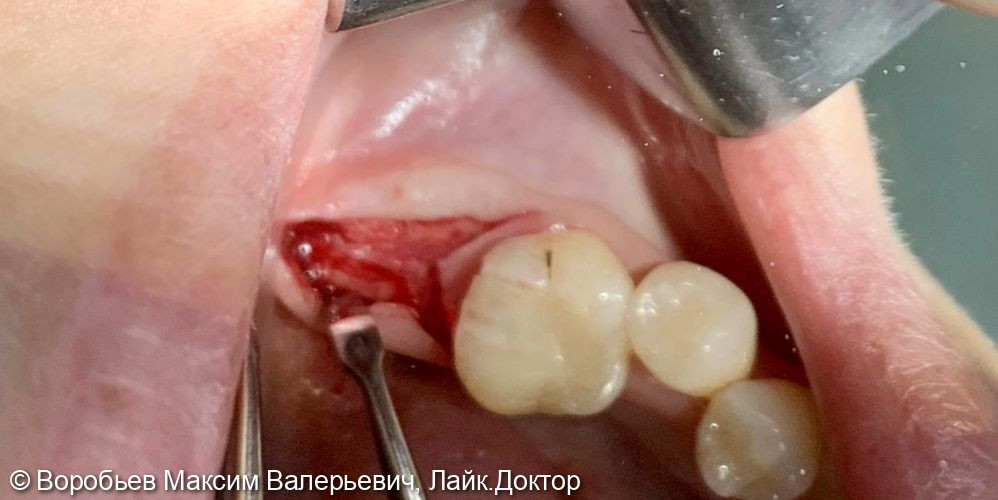 имплантация в области 37 го зуба - фото №1
